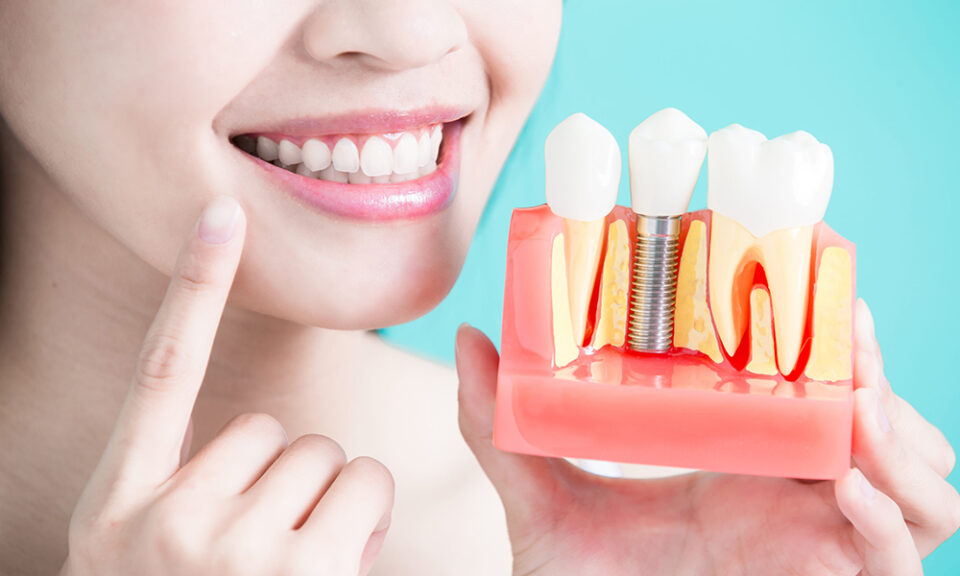dental implants